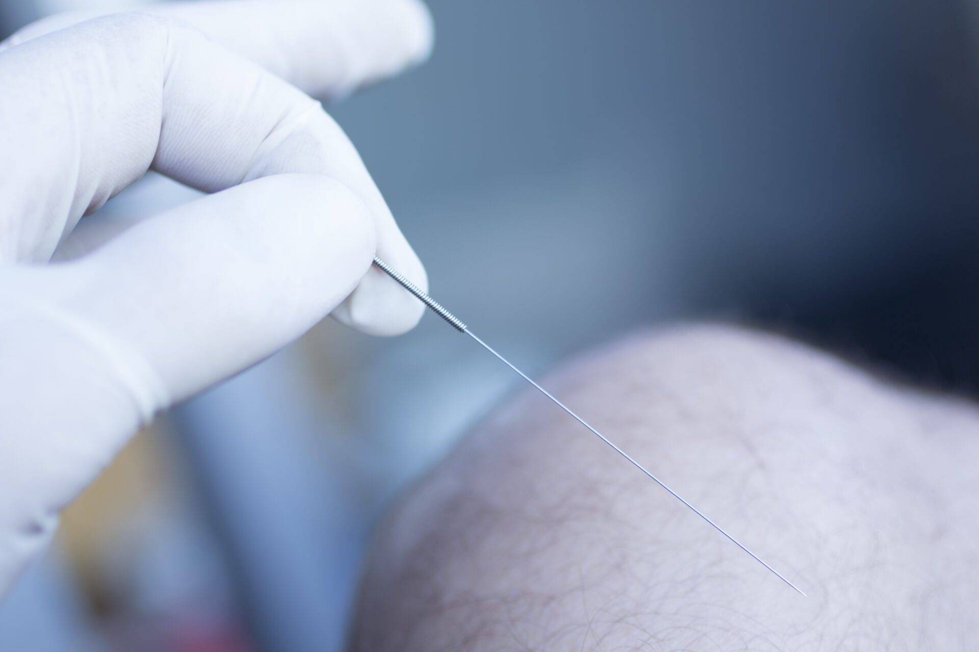Acupuncture needle used for dry needling rehabilitation medical treament for physiotherapy and pain due to physical injury in the hand of the doctor.