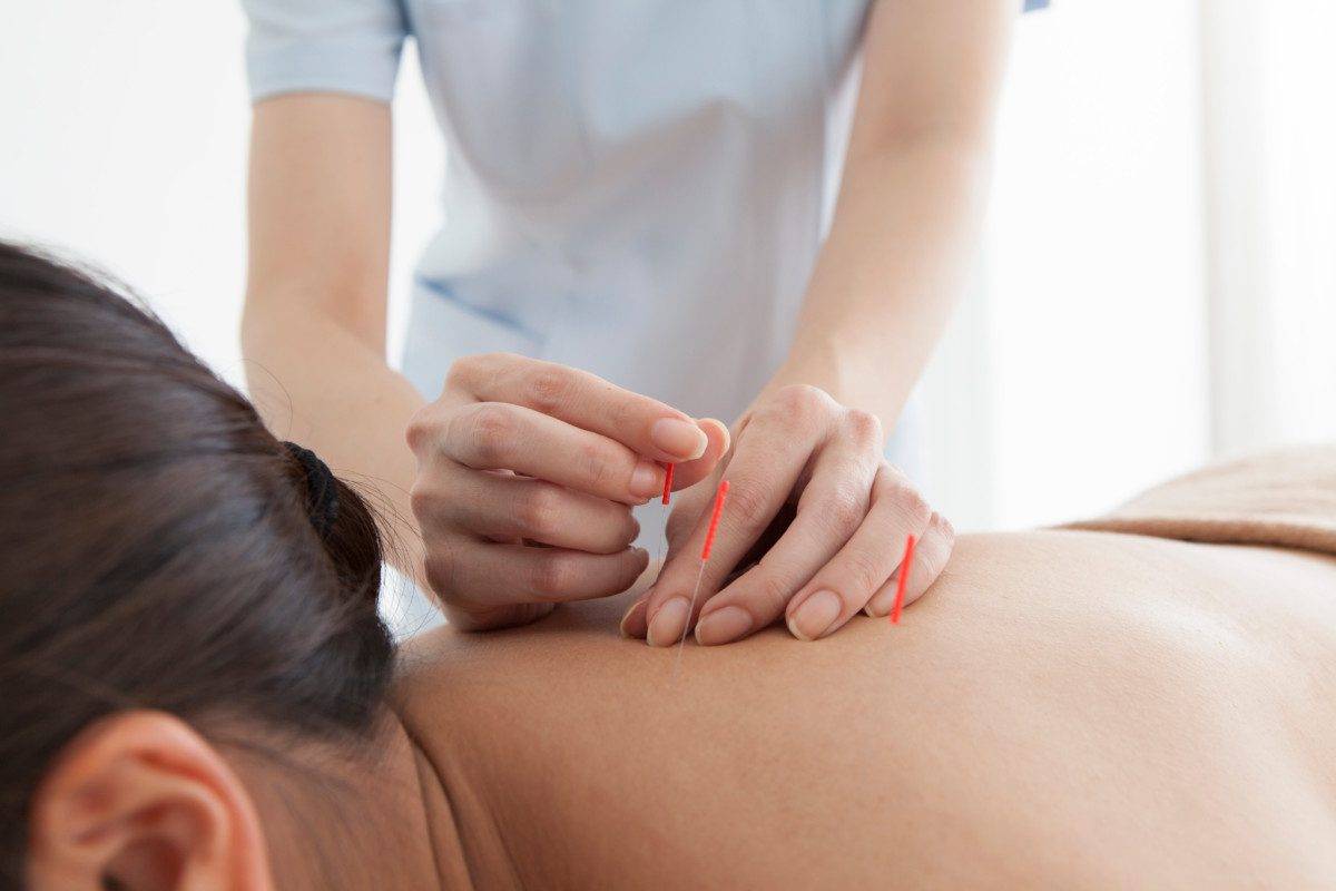 Women who are relaxed by receiving acupuncture on his back