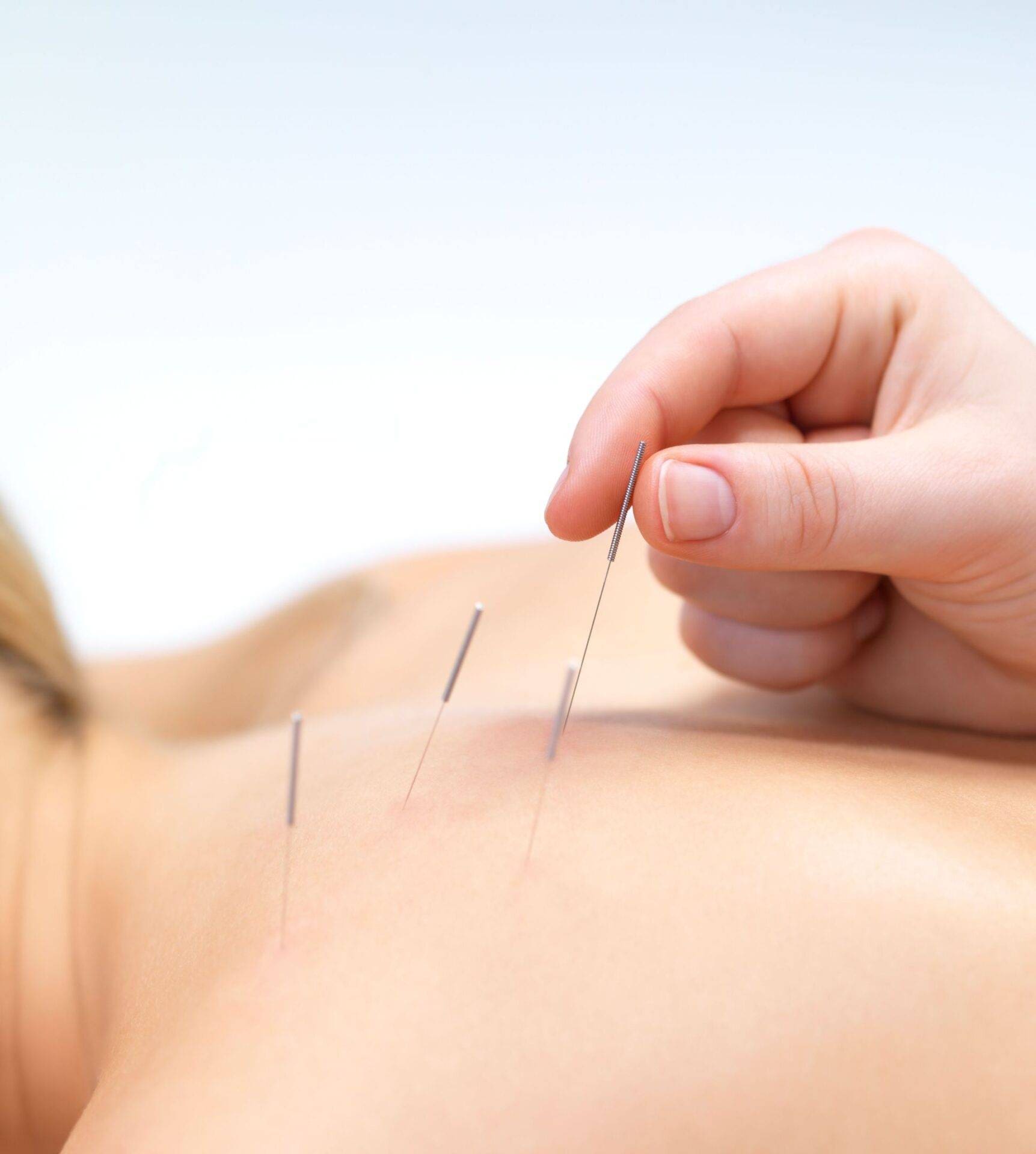 a woman getting acupuncture on her back